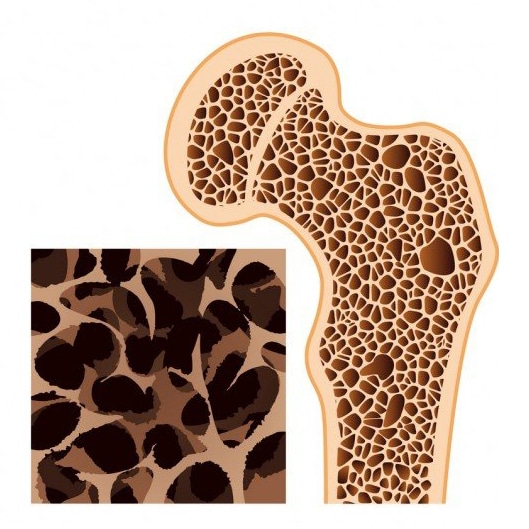 Diagram of bone structure during Osteoporosis